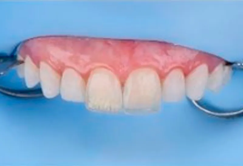 Clinical Skills Facetas em Resinas Compostas