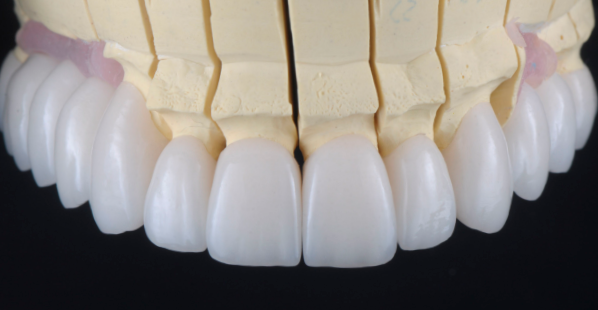 Reabilitações Cerâmicas